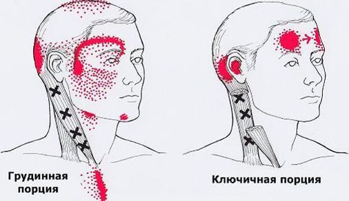 Карта точек боли в теле и точек напряжения мышц (триггеры)