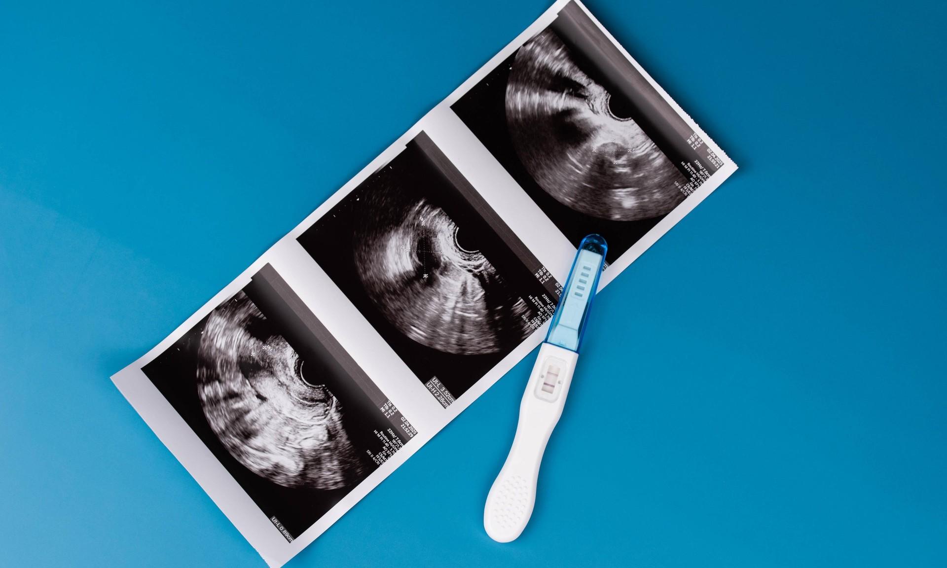 Что такое биохимическая беременность: признаки и возможные причины