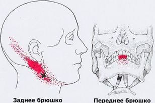 Карта точек боли в теле и точек напряжения мышц (триггеры)