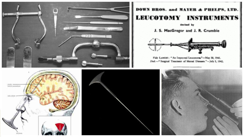 Хирургические инструменты душевнобольные, история медицины, лоботомия, операция