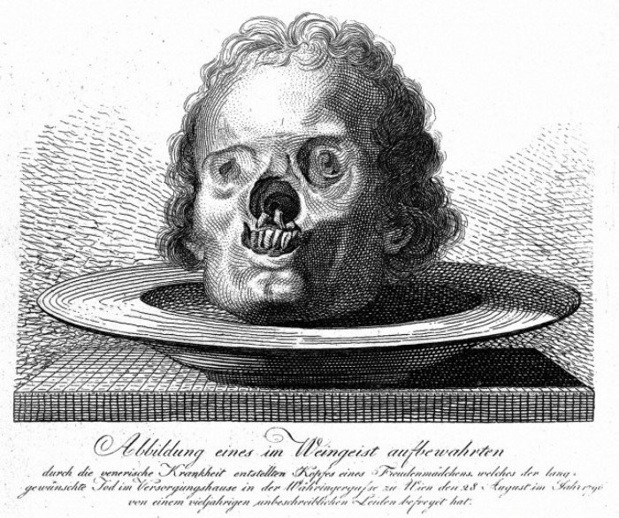 История «путешествия» сифилиса в Европу болезнь, история, путешествия, факты