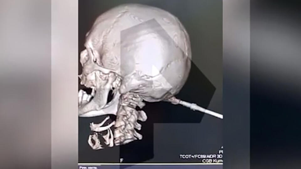Жителю Башкирии провели трепанацию черепа из-за застрявшей отвертки