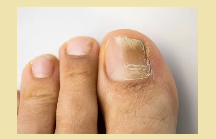 Ногти на пальцах ног желтеют, чернеют, белеют, отходят и слоятся — почему: причины, лечение, профилактика ногтей, пальцах, заболевания, болезни, ногтевой, пластины, ногти, ногтя, может, патологии, ноготь, лечения, пальцев, грибок, только, ногтевых, ногах, избежать, цвета, организма