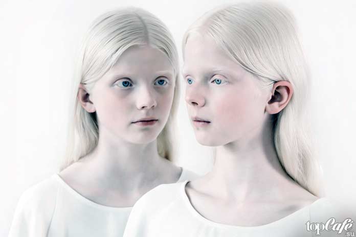 Люди альбиносы: люди альдиносы