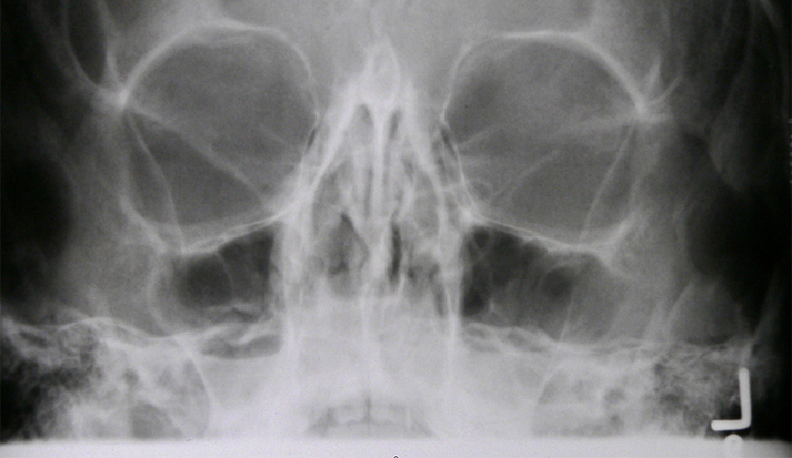 Гайморит на рентгене: основные признаки болезни, особенности лечения, рекомендации врачей