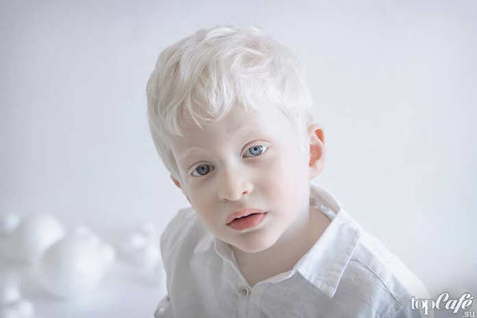Люди альбиносы: мальчик