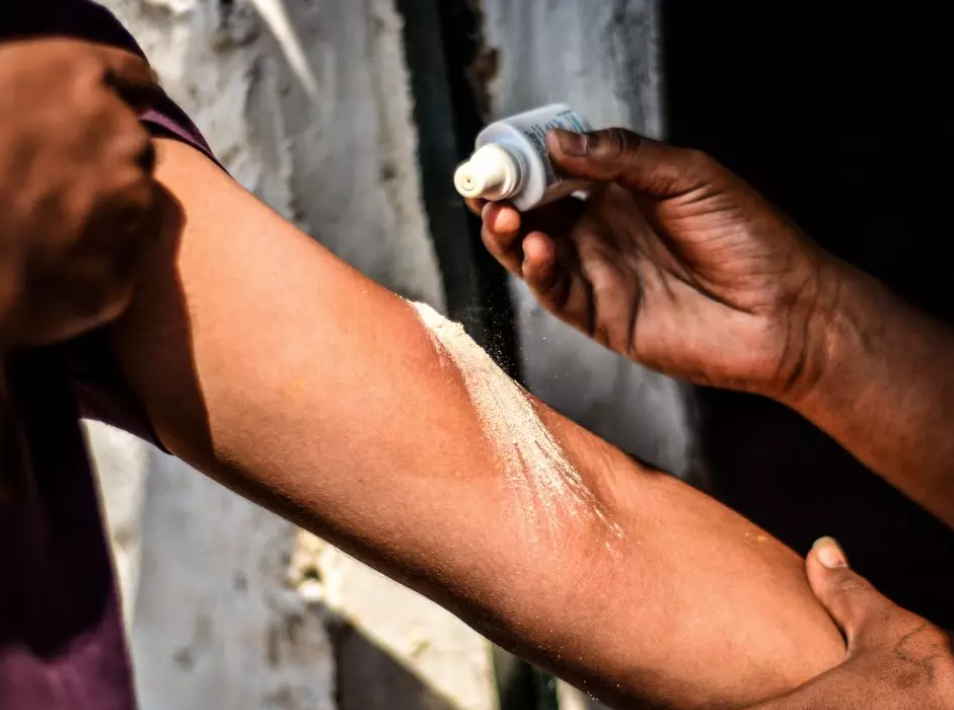 Стрептоцид - и никаких рубцов и пересадок кожи. Простое лечение сильных ожогов