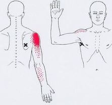 Карта точек боли в теле и точек напряжения мышц (триггеры)