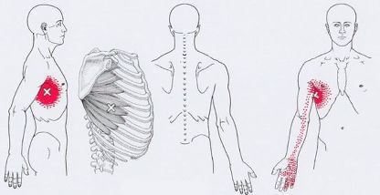 Карта точек боли в теле и точек напряжения мышц (триггеры)