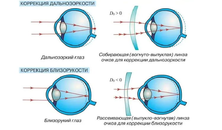 Как исправить дефекты зрения?