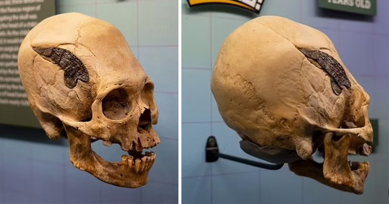 Скрепленный металлом 2000 лет назад человеческий череп поразил ученых