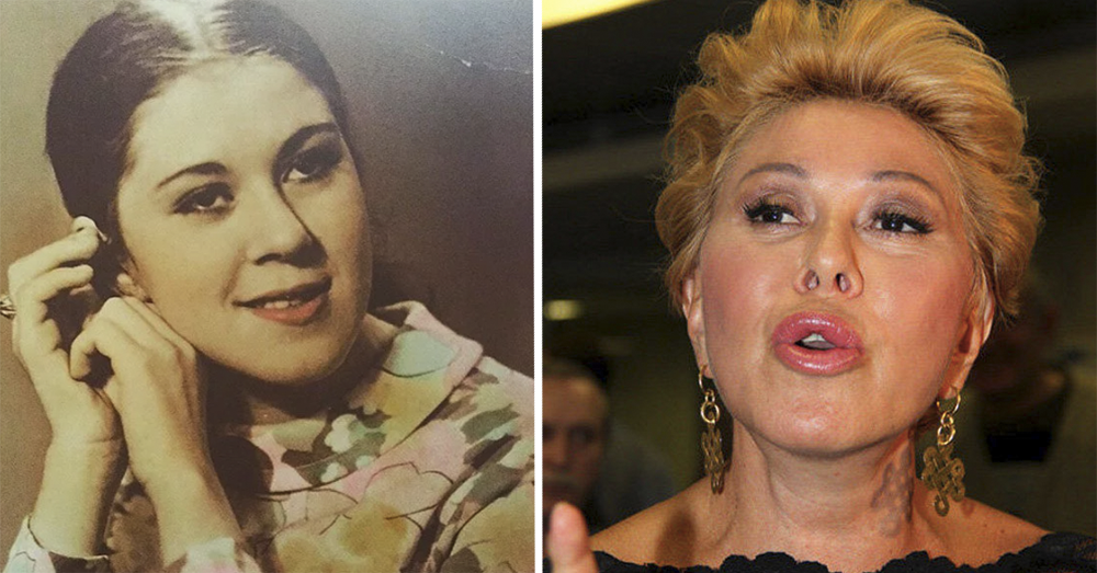 Заячья губа у знаменитостей фото до и после операции россии