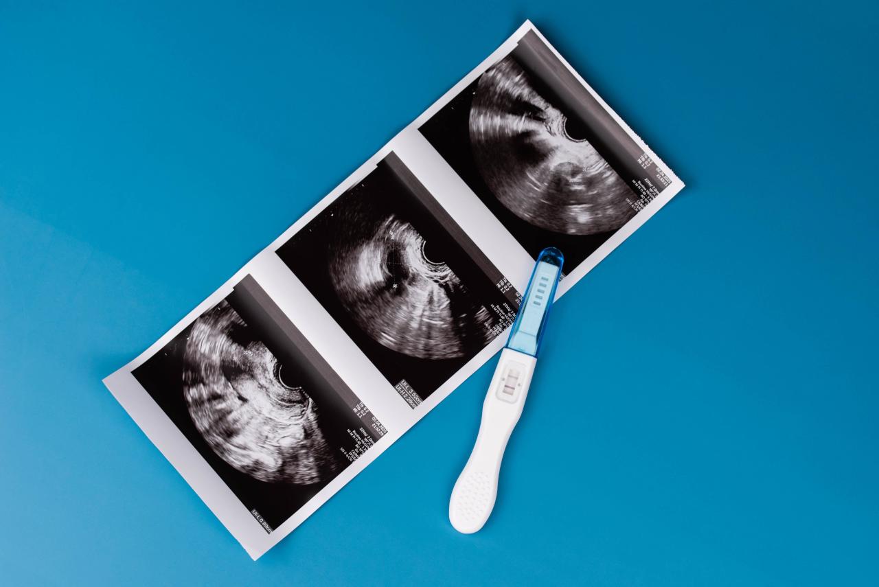 Что такое биохимическая беременность: признаки и возможные причины беременность, может, беременности, уровень, Карина, биохимическую, неделю, кровотечение, обычно, можно, которое, такое, биохимической, сообщила, крови, только, через, теста, сроке, визуализируется