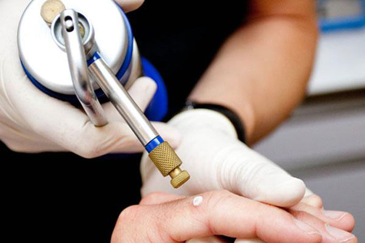 ÐšÐÑ€Ñ‚Ð¸Ð½ÐºÐ¸ Ð¿Ð¾ ÐÐÐ¿Ñ€Ð¾ÑÑƒ liquid nitrogen cryotherapy