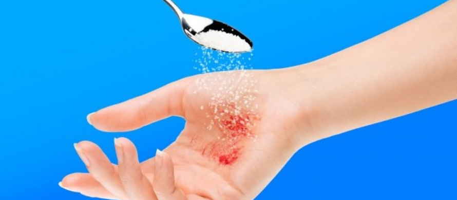 Стрептоцид - и никаких рубцов и пересадок кожи. Простое лечение сильных ожогов