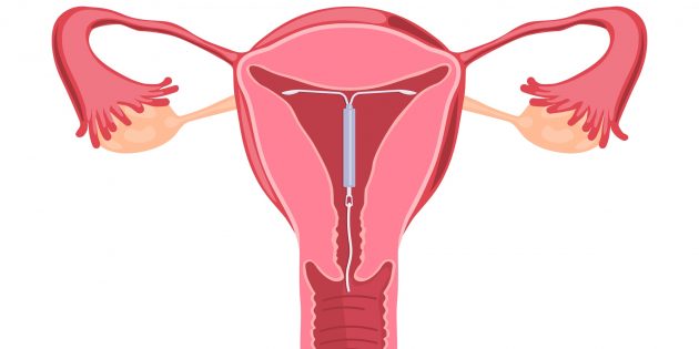 Схема расположения контрацептива в матке