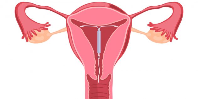 Внутриматочная спираль: чем хорош и чем плох этот метод контрацепции спирали, спираль, может, матки, внутриматочная, установки, можно, использовать, которые, время, беременности, контрацепции, после, стоит, полости, жизни, Поэтому, могут, видны, установке