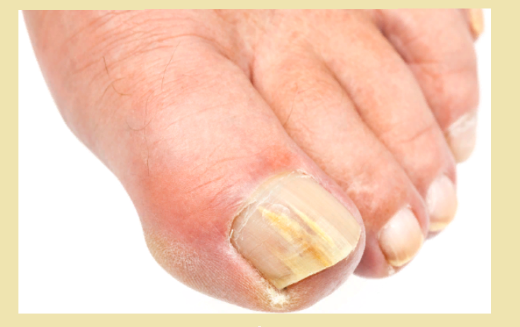 Ногти на пальцах ног желтеют, чернеют, белеют, отходят и слоятся — почему: причины, лечение, профилактика ногтей, пальцах, заболевания, болезни, ногтевой, пластины, ногти, ногтя, может, патологии, ноготь, лечения, пальцев, грибок, только, ногтевых, ногах, избежать, цвета, организма