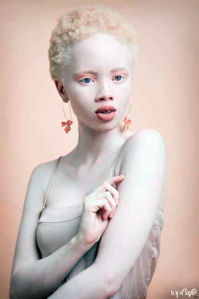 Люди альбиносы: Thando Hopa