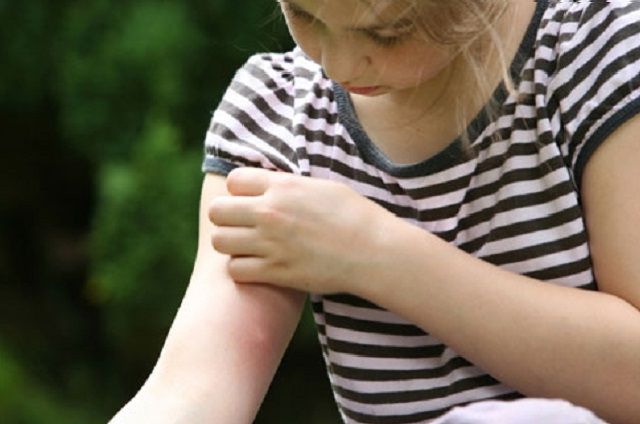 Укус комара - неотъемлемая часть летнего отдыха.