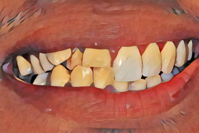 Почему у одних людей зубы кривые, а у других ровные?