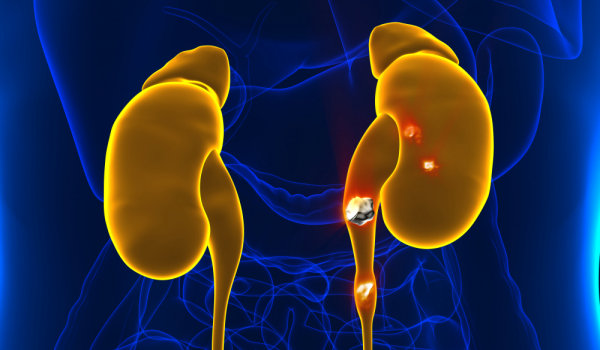 Камни в почках