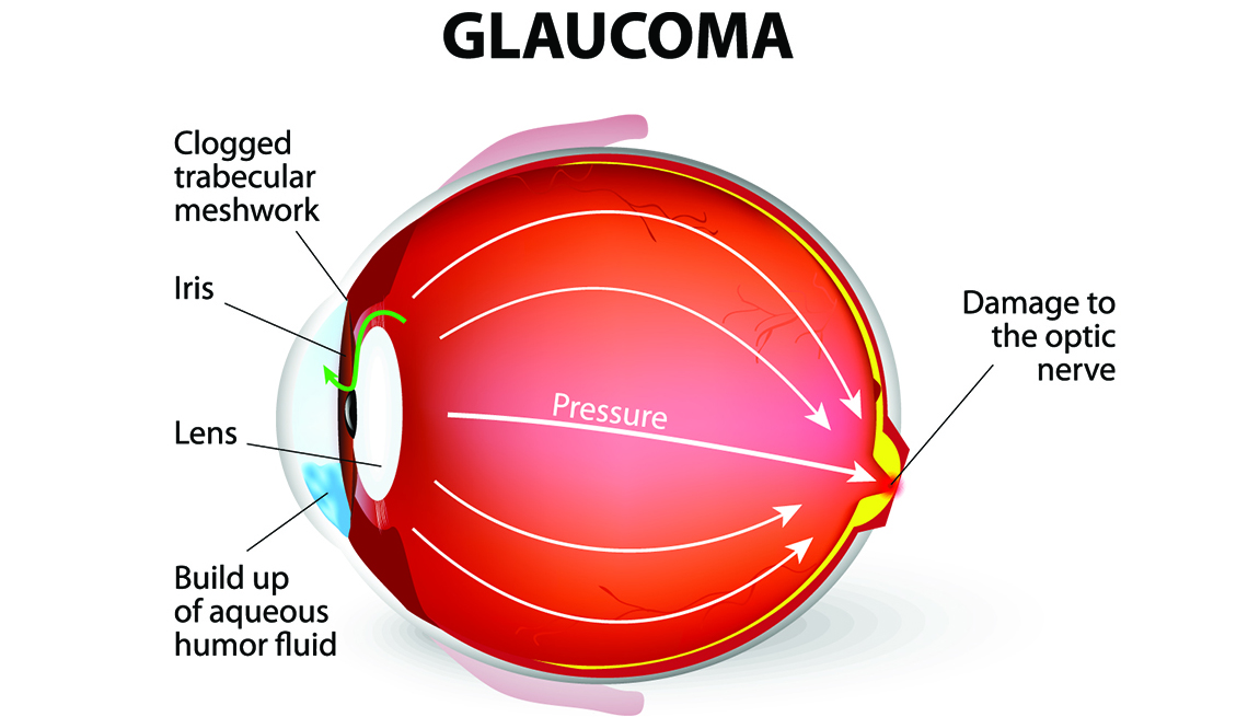 Глаукома: какие обследования нужны