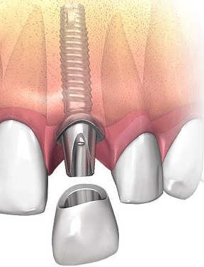 Зубные импланты: виды, показания, особенности здоровье