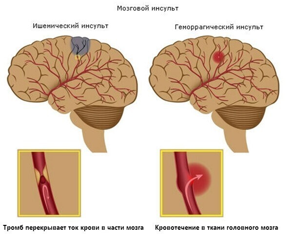 Факторы, провоцирующие развитие болезни