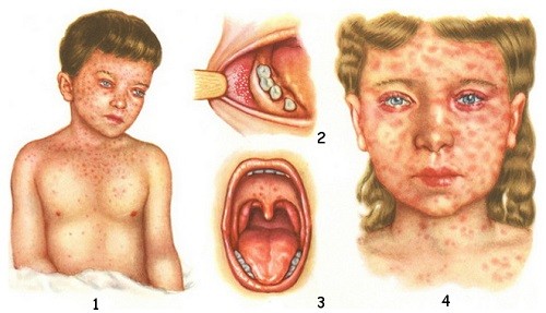 У большинства корь пройдёт без последствий — лихорадка, сыпь, выздоровление.
