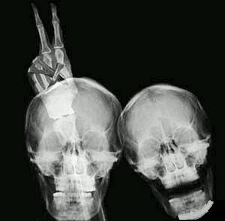 Рентген девушки гимнастки в прогибе и другие фото-приколы с рентгеном. 10 забавных фото рентгена мужчин и женщин 
Рентген человека, как вид современного искусства: байкер, девушка гимнастка в прогибе, целующиеся люди и другие фото-приколы на рентгеновских снимках
