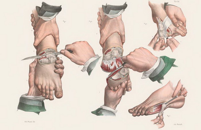 Как делали хирургические операции в начале прошлого века Как делали хирургические операции в начале прошлого века