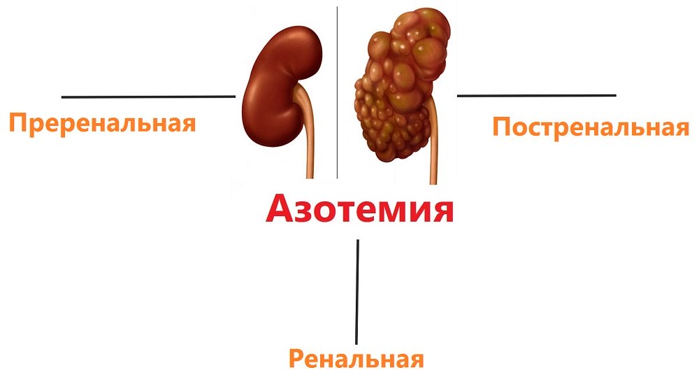 Азотемия, что это и какие виды бывают