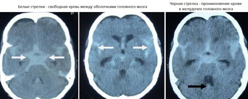 Чихание закрытым ртом убивает. Клинические случаи