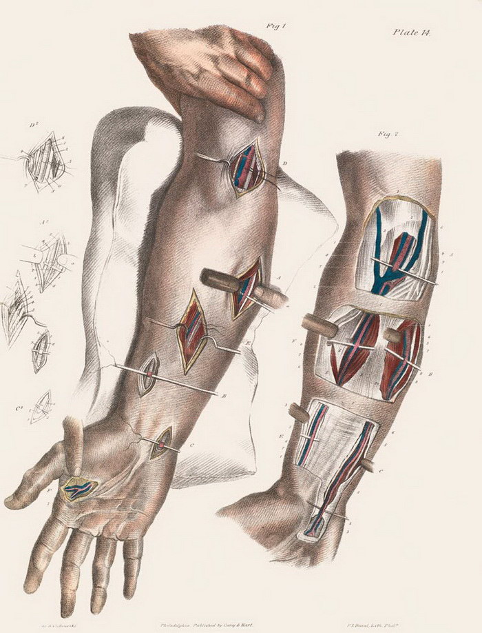Как делали хирургические операции в начале прошлого века Как делали хирургические операции в начале прошлого века