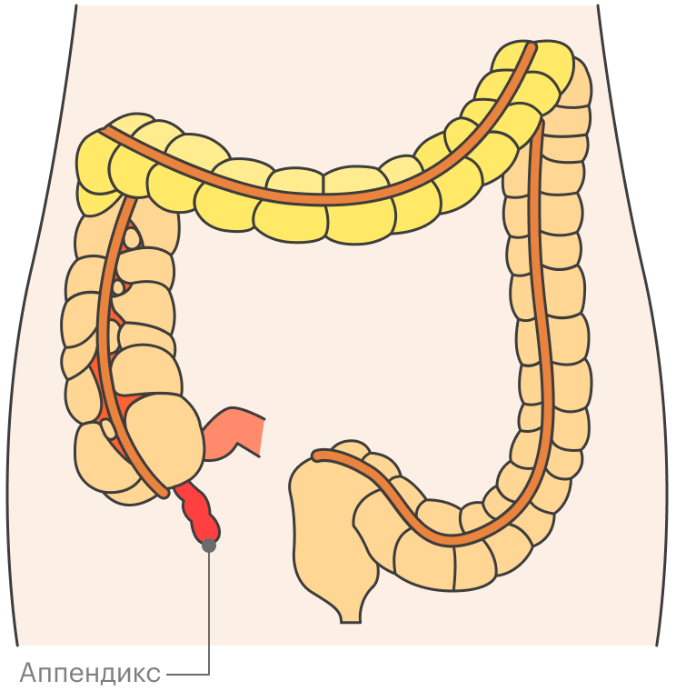 Аппендикс — участок толстой кишки. Когда он воспаляется, возникает аппендицит