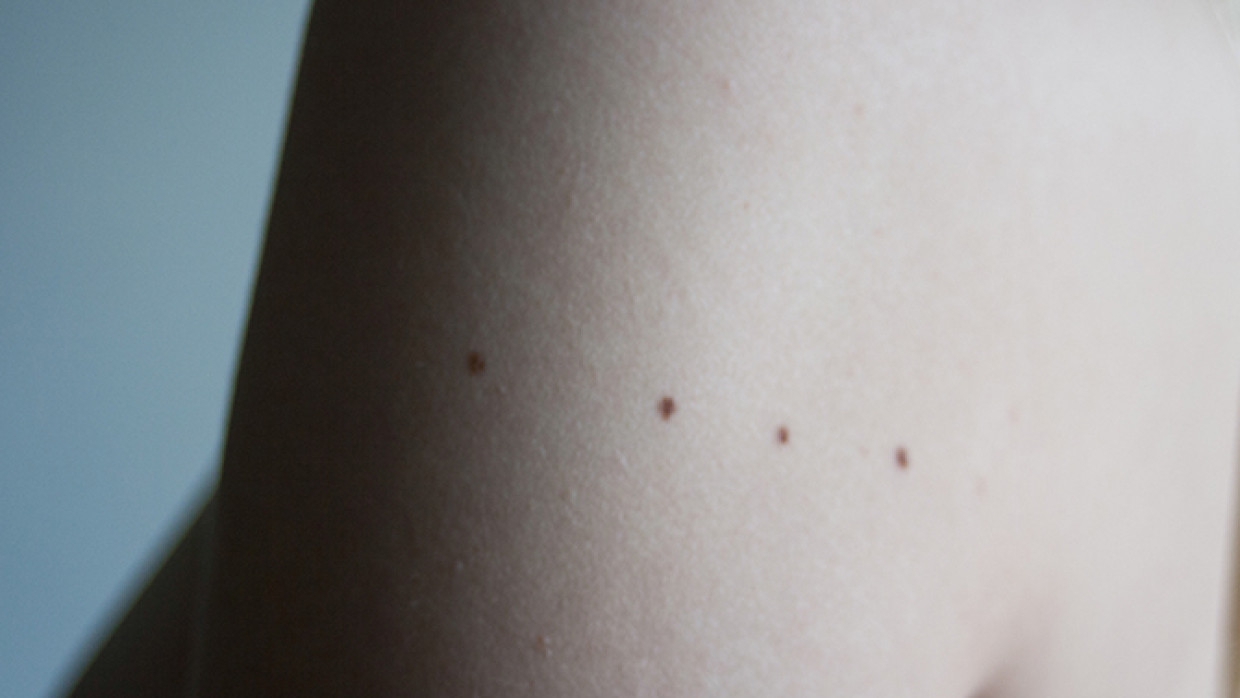 Родинки на теле человека могут помочь при лечении меланомы