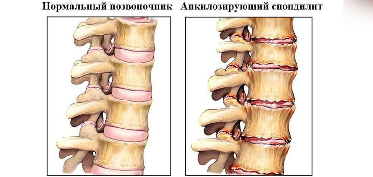 Откуда скованность по утрам, и почему не отдыхаешь за ночь скованность, после, утренняя, утренней, суставов, крови, более, всего, пострадают, случае, быстро, маркер, мышцы, позвоночника, Бехтерева, мышечных, длительного, воспаления, активностью, аэробной