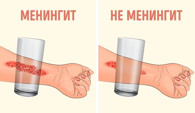 8-pervyx-priznakov-meningita-kotorye-dolzhna-znat-kazhdaya-mama_008
