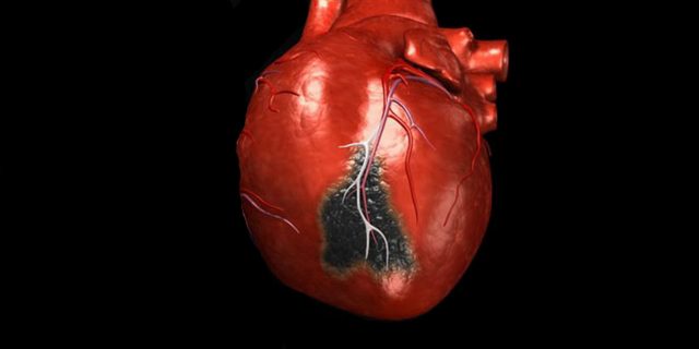 На что может быть похож инфаркт миокарда