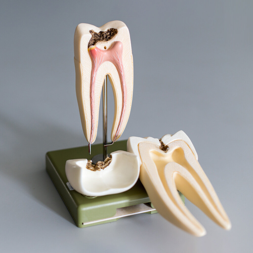 Насколько опасен мертвый зуб для нашего организма зубы,стоматология