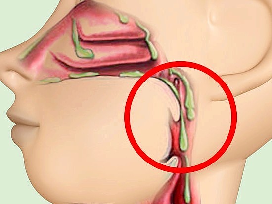 Картинки по запросу Из-за чего в горле скапливается слизь и как от нее избавиться