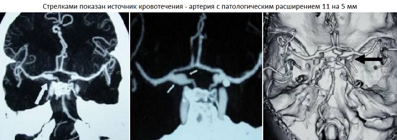 Чихание закрытым ртом убивает. Клинические случаи