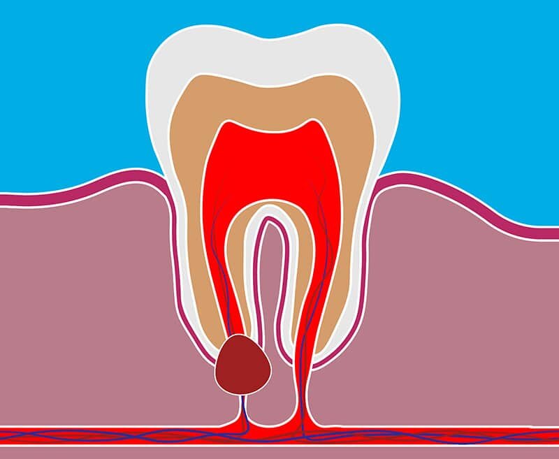 Как лечить кисты и гранулемы с точки зрения современной стоматологии