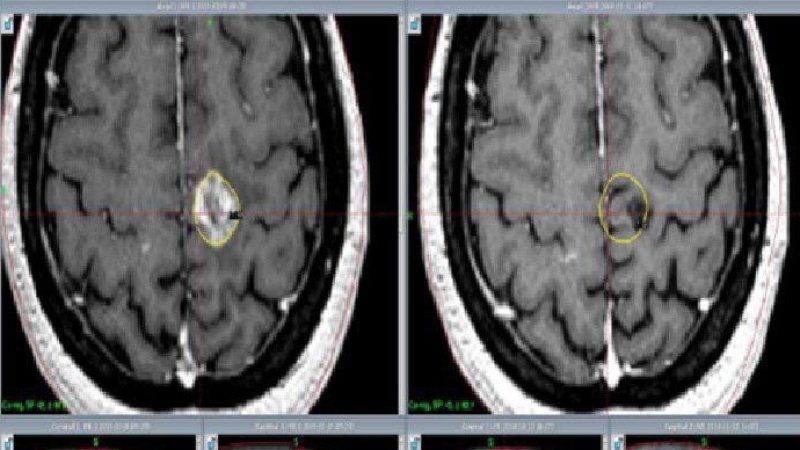 До и после лечения глиальной опухоли. Фото: ОКБ ХМАО-Югры