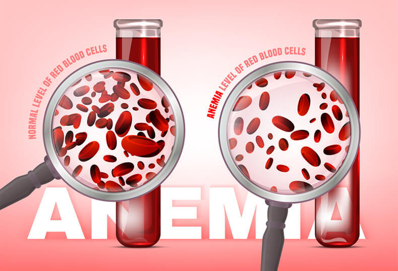 Анемия: Какие продукты нарушают всасывание железа  анемия,здоровье и медицина, кровь, малокровие