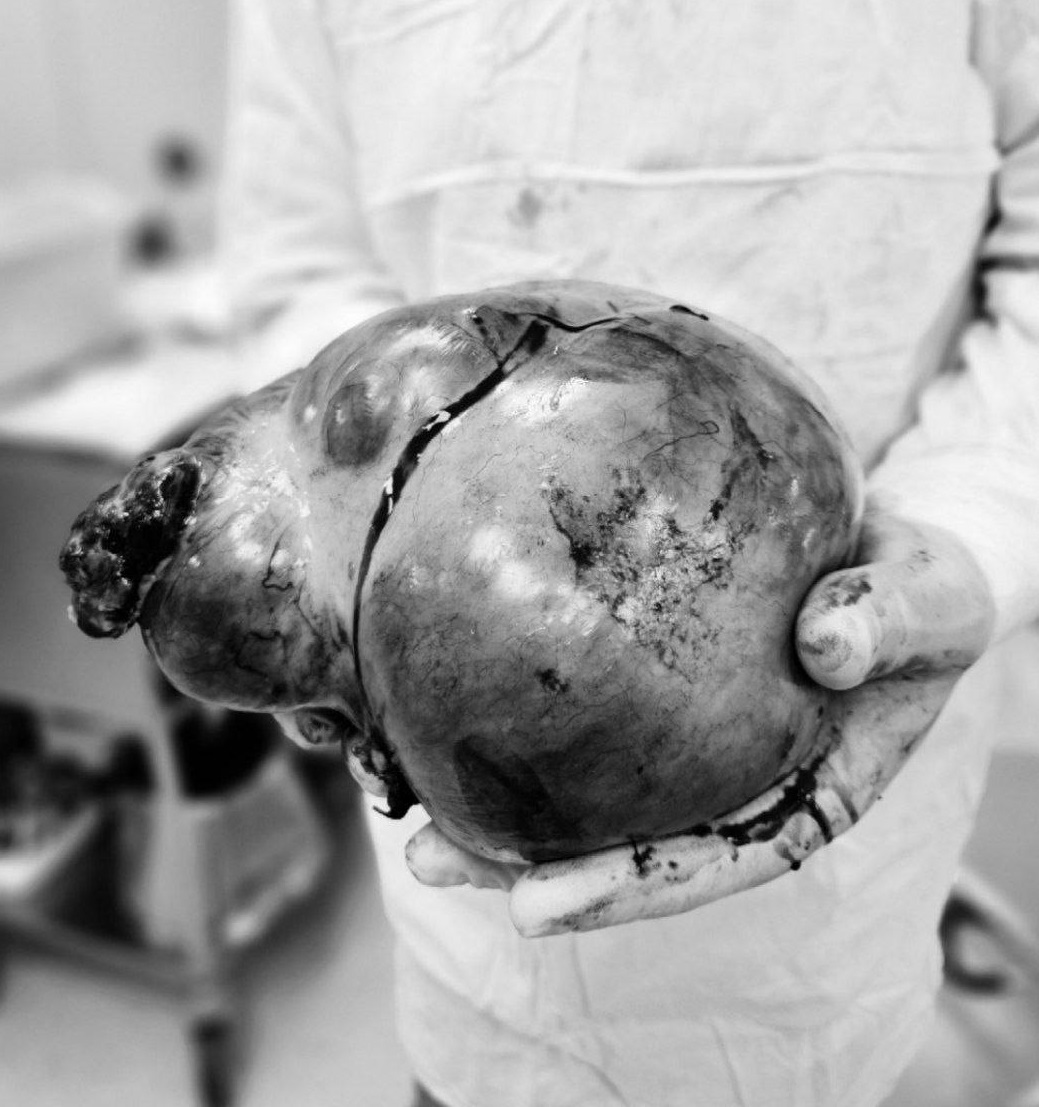 В Подмосковье 17-летней девушке удалили гигантскую семикилограммовую опухоль