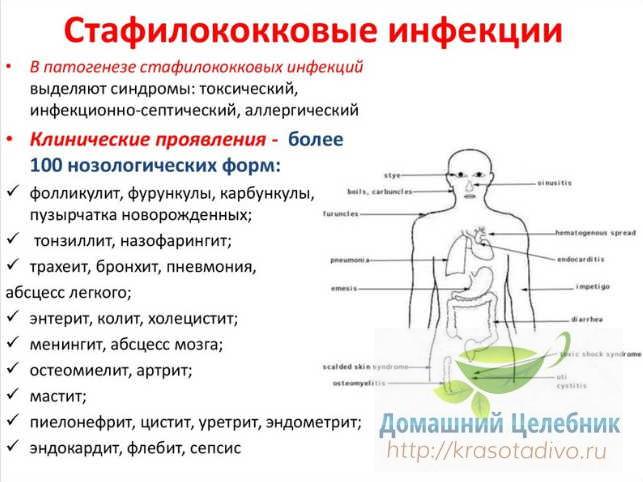 Лечение стафилококковой инфекции. Симптомы стафилококковой инфекции. Клинические проявления стафилококковой инфекции. Стафилококковая инфекция на коже. Симптомы стафилококковой инфекции у взрослого.