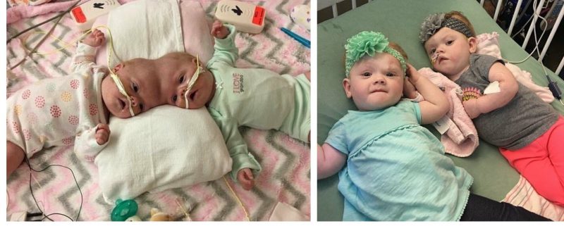 Право на жизнь: 1,5-годовалые сиамские близнецы, родившиеся со сращенными головами, восстановились после сложнейшей операции и радуются каждому дню