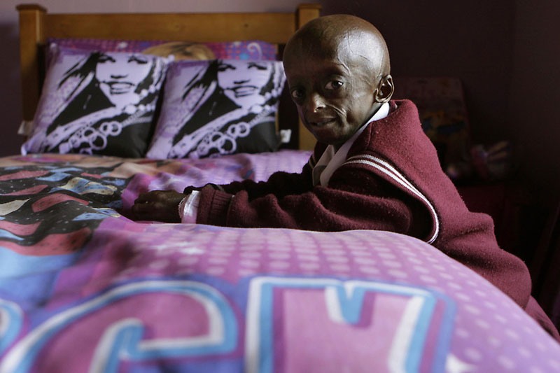 South Africa Progeria Girl